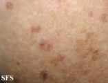 porokeratosis actinic