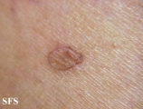 porokeratosis actinic