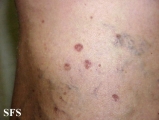 porokeratosis actinic