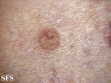 porokeratosis actinic