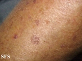 porokeratosis actinic