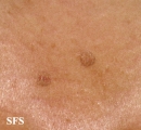 porokeratosis actinic