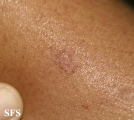 porokeratosis actinic