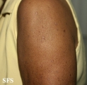 porokeratosis actinic