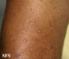 porokeratosis actinic