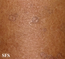 porokeratosis actinic