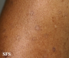 porokeratosis actinic