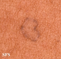 porokeratosis actinic