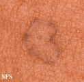 porokeratosis actinic