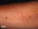 porokeratosis actinic