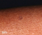 porokeratosis actinic