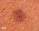 porokeratosis actinic