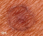 porokeratosis actinic