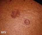 porokeratosis actinic