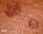 porokeratosis actinic