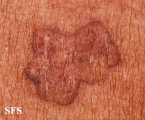 porokeratosis actinic