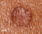 porokeratosis actinic
