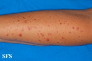 porokeratosis actinic