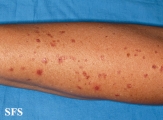 porokeratosis actinic