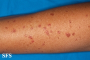 porokeratosis actinic