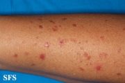 porokeratosis actinic