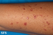 porokeratosis actinic