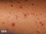 porokeratosis actinic