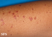 porokeratosis actinic