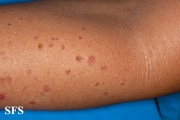 porokeratosis actinic