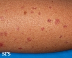 porokeratosis actinic