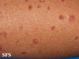porokeratosis actinic