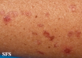 porokeratosis actinic