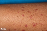 porokeratosis actinic