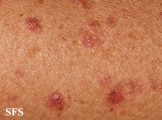 porokeratosis actinic