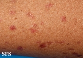 porokeratosis actinic