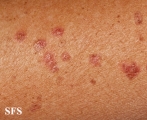 porokeratosis actinic
