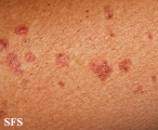 porokeratosis actinic