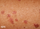 porokeratosis actinic
