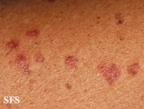 porokeratosis actinic