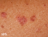 porokeratosis actinic
