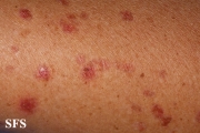 porokeratosis actinic