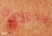 porokeratosis actinic
