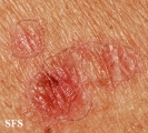 porokeratosis actinic