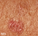 porokeratosis actinic