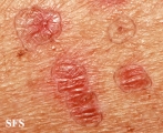 porokeratosis actinic