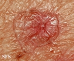 porokeratosis actinic