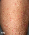 porokeratosis actinic