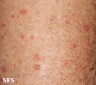 porokeratosis actinic