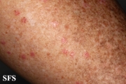 porokeratosis actinic