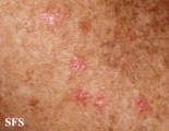 porokeratosis actinic